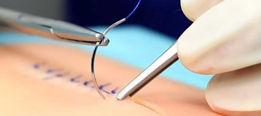punto de sutura